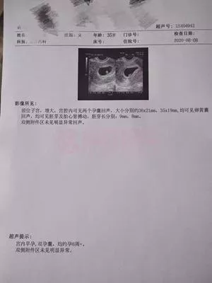 35岁女方多囊卵巢综合症，男方弱精，三代试管婴儿一次怀双胞胎男孩